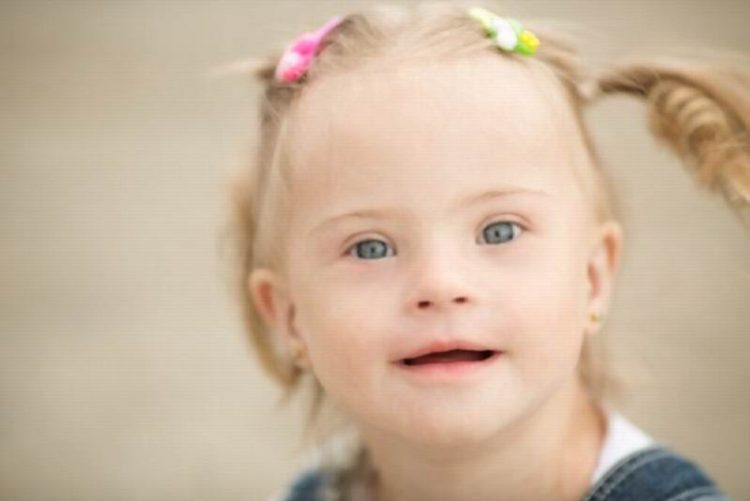 Blue Baby Syndrome Causes, Symptoms, Diagnosis and Treatments