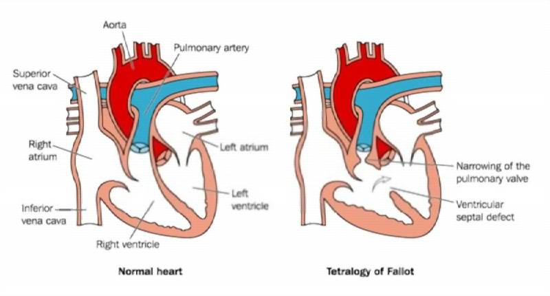 Tetralogy of Fallot