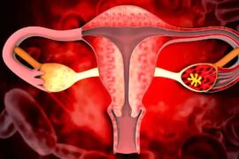 Causes and treatment of uterine fibroids.