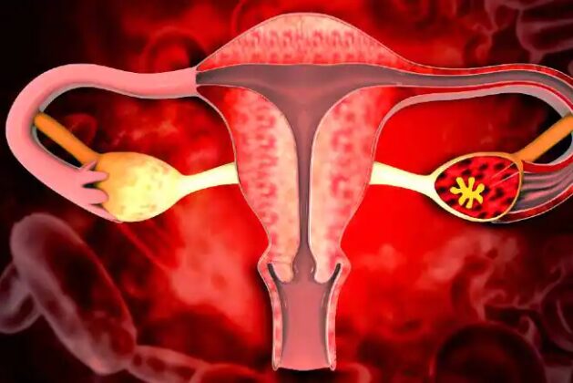 Causes and treatment of uterine fibroids.