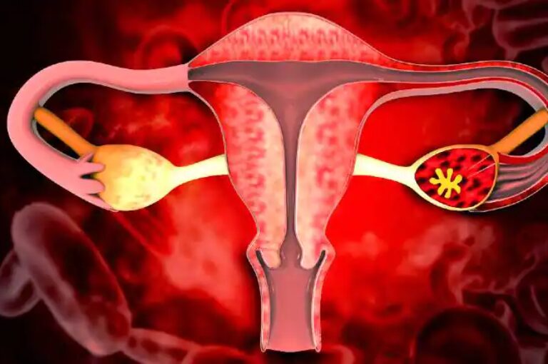 Causes and treatment of uterine fibroids.