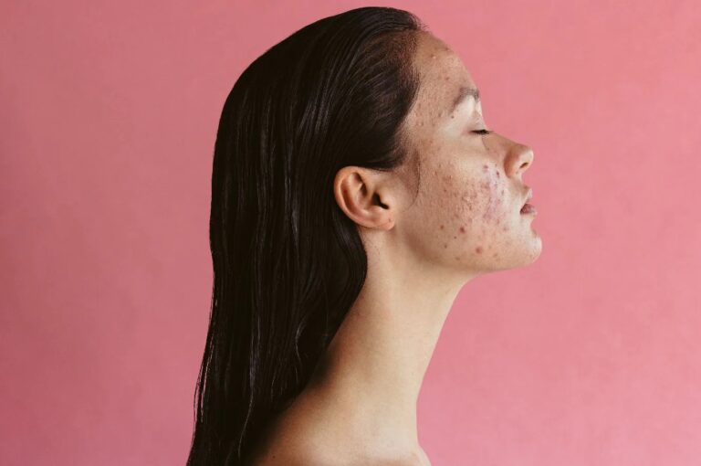 How to manage acne related to pcos and the reasons for it