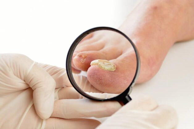 5 Home Remedies To Get Rid Of Toenail Fungal Infection- These 5 Home Remedies Can Treat Toenail Fungal Infection.