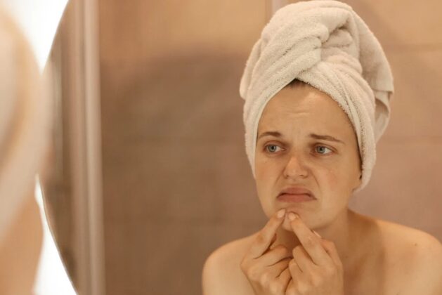 Here are some tips to avoid acne and pimples.- Here are some tips to get rid of acne and pimples.