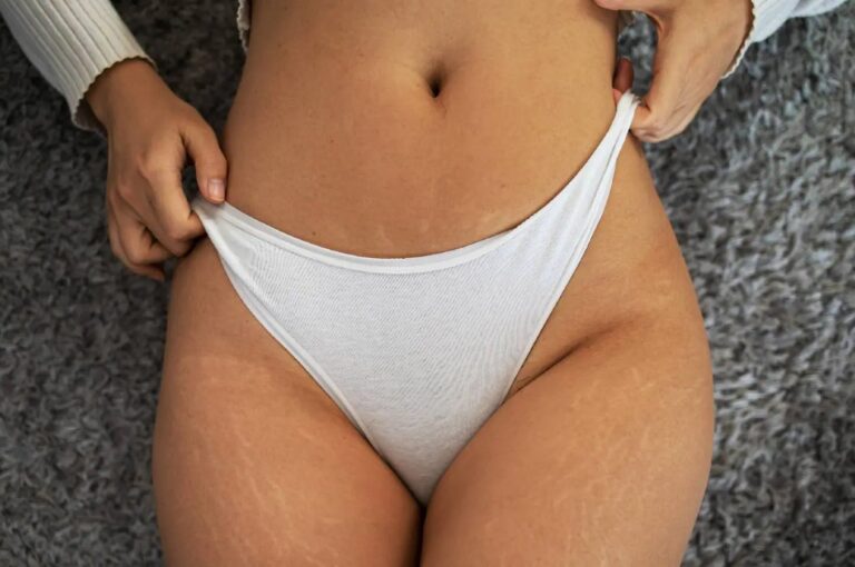 How to reduce stretch marks – Know how to reduce stretch marks
