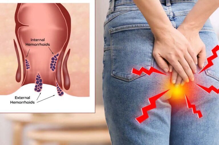 These 6 foods in your diet may make hemorrhoid symptoms worse.