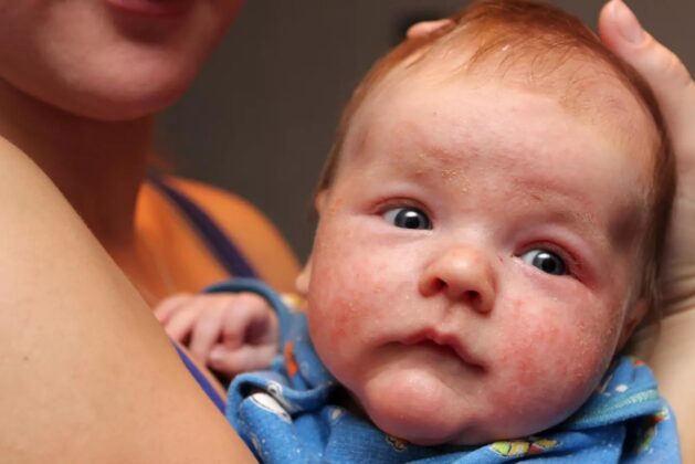 Know the symptoms, causes and treatment of childhood eczema.