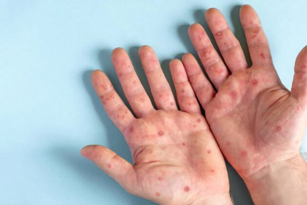 Can monkeypox cause heart problems?