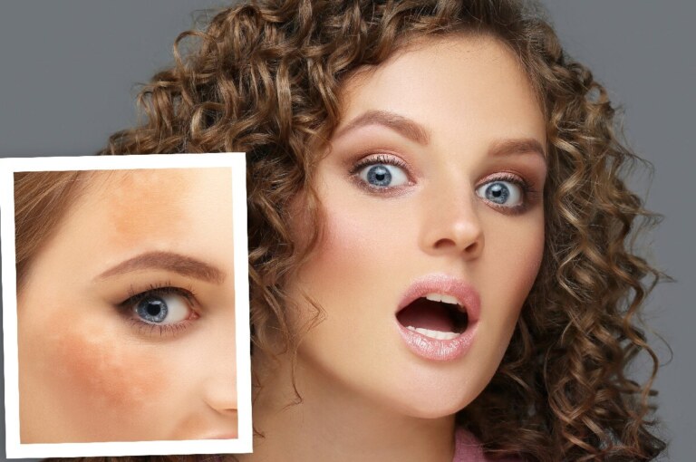 reasons why you can’t get rid of pigmentation with pooja makhija
