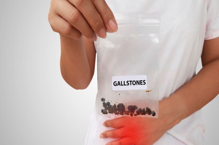 These are the causes of stones in the stomach. Causes and prevention of urinary stones.