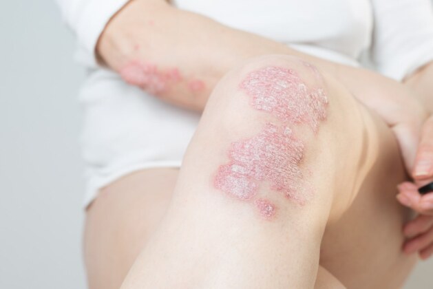 Know the causes of psoriasis and tips to avoid it.- What are the causes of psoriasis and ways to avoid it.