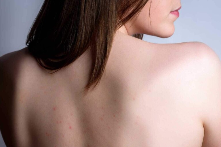How to get rid of back acne
