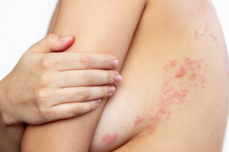 know about breast rash symptoms, causes and treatment