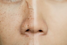 Know how to get rid of pigmentation at home.- Know here 4 ways to get rid of freckles.