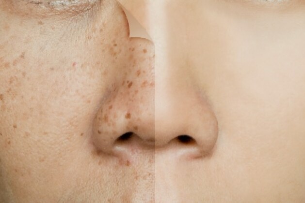 Know how to get rid of pigmentation at home.- Know here 4 ways to get rid of freckles.