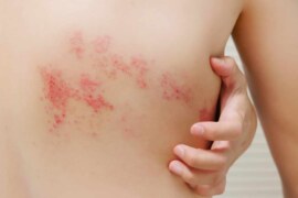 Shingles Awareness Week 2023: Learn about this painful skin disease and how to prevent it