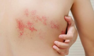 Shingles Awareness Week 2023: Learn about this painful skin disease and how to prevent it