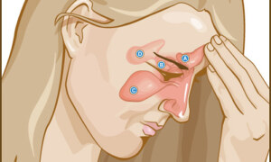 Is a Sinus Infection Contagious? Unraveling the Contagion Conundrum