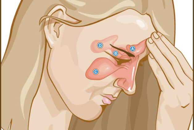 Is a Sinus Infection Contagious? Unraveling the Contagion Conundrum