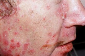 Psoriasis on Face: Understanding, Managing, and Thriving