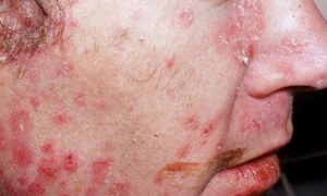 Psoriasis on Face: Understanding, Managing, and Thriving