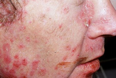 Psoriasis on Face: Understanding, Managing, and Thriving