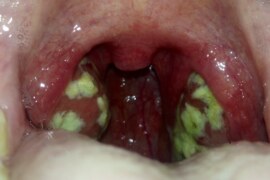 White Spots in Throat: Understanding Causes and Solutions