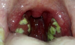 White Spots in Throat: Understanding Causes and Solutions